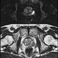 PROSTATE_DWI/T2